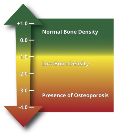 T-score chart showing bone mineral density scores.