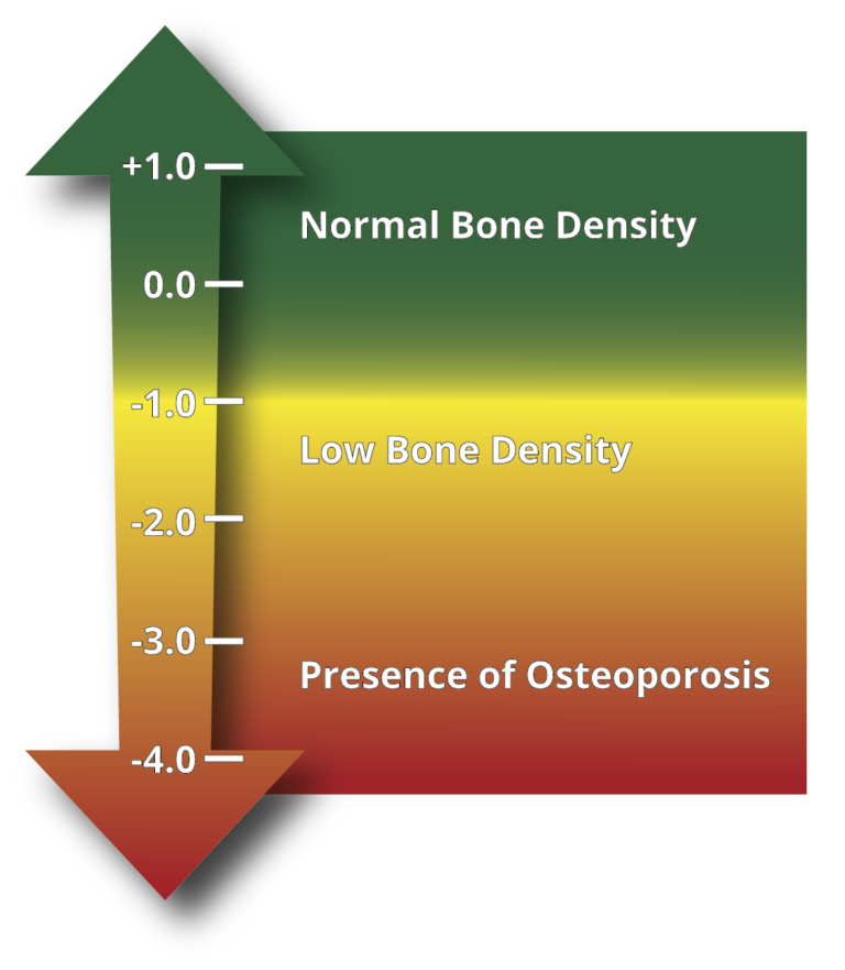 Bone Health & Osteoporosis - IslandHealth.org