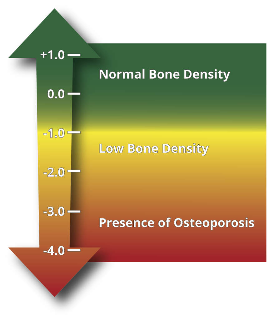 Bone Health & Osteoporosis - IslandHealth.org